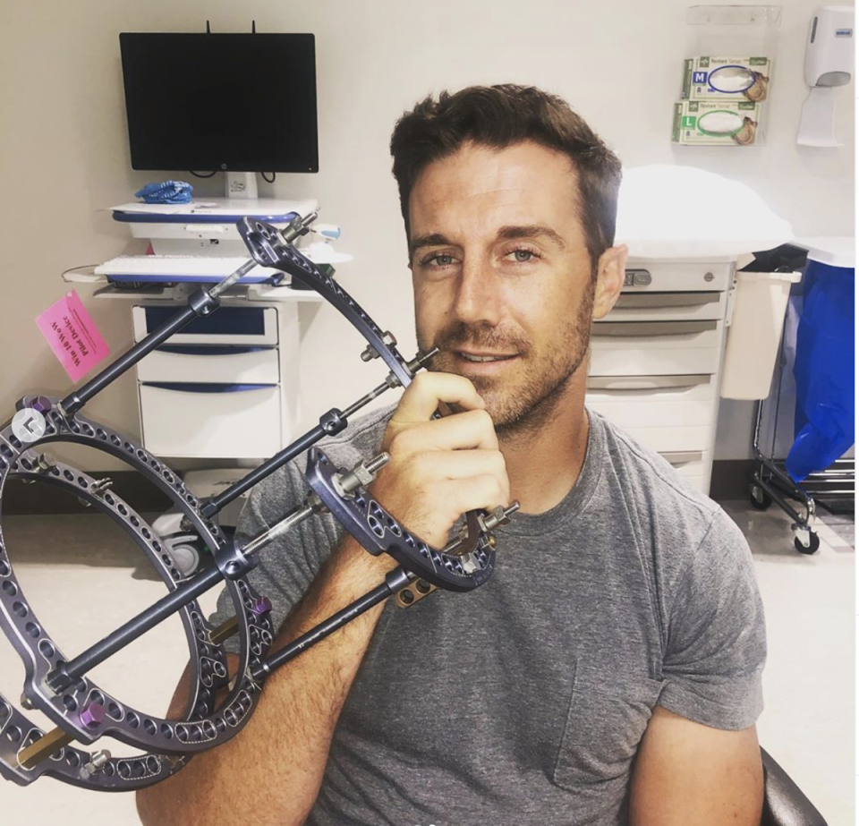 Washington quarterback Alex Smith had the external fixator removed from his injured right leg on Monday. The device played a significant role in the healing of his broken bone. (Liz Smith/Instagram)