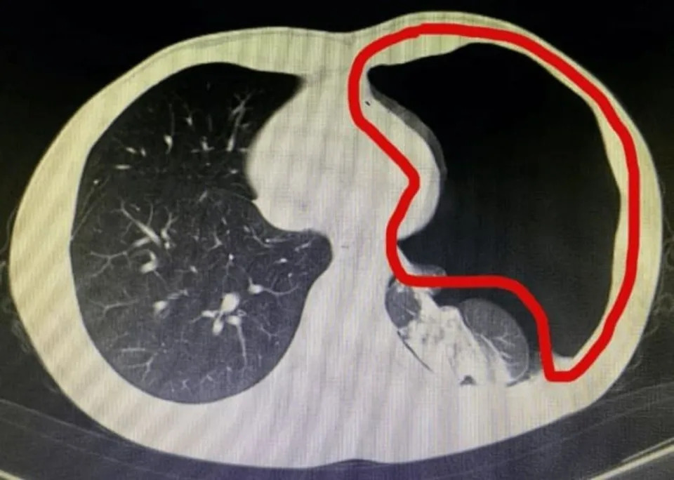 25歲男因大便太用力，導致氣胸發作，左側肺部被異常壓縮近9成。（翻攝自杭州市衛生健康委員會官網）