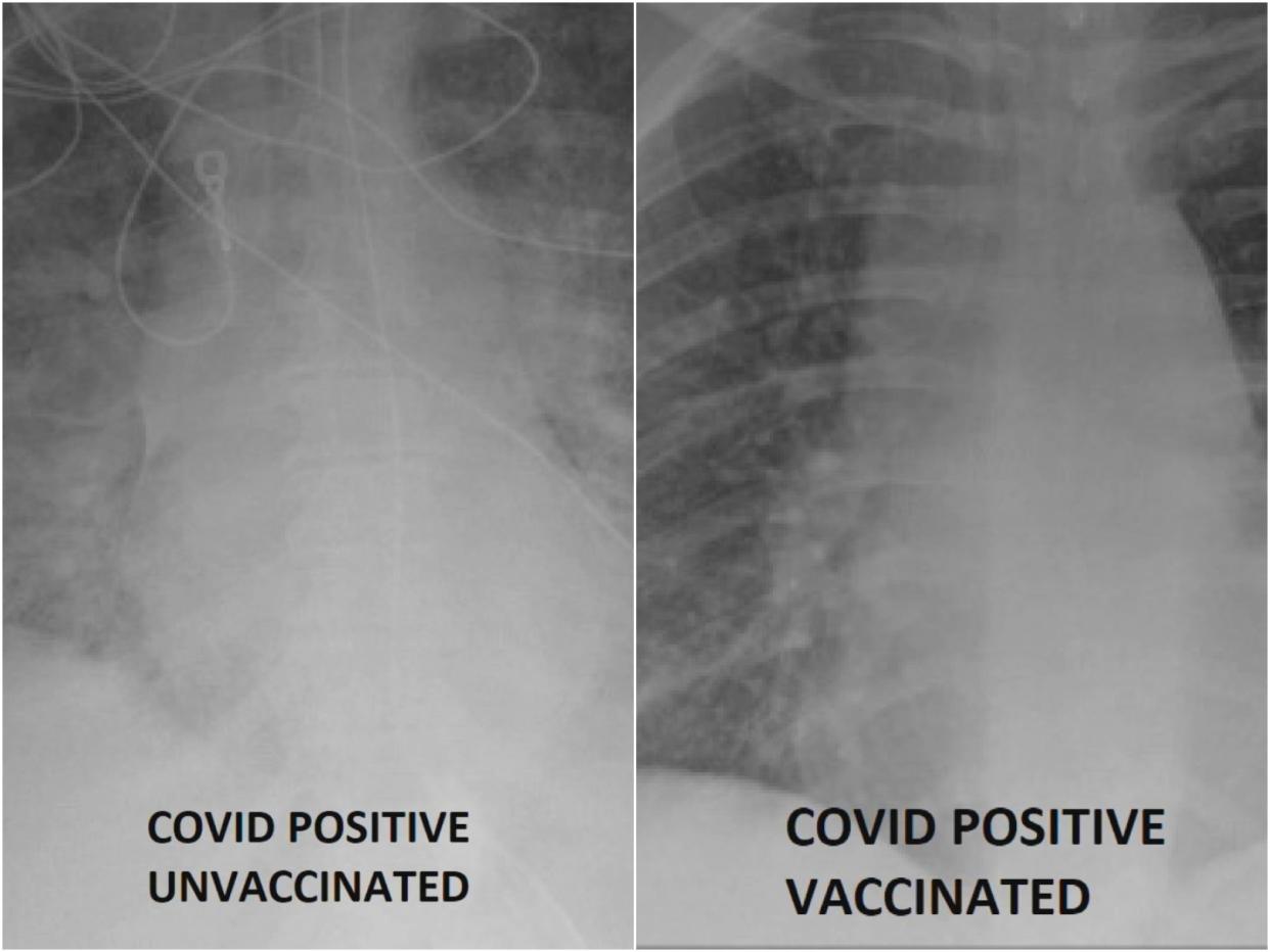 A St Louis doctor has chared X-ray images showing the importance of getting the Covid-19 vaccine.  (KSDK)