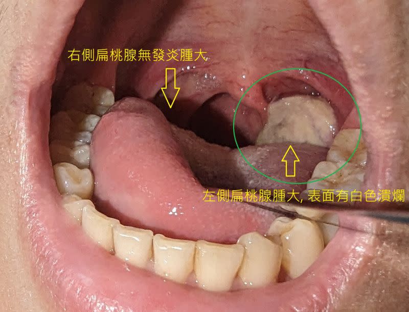 ▲女子左側扁桃腺上的「白色爛肉」其實是癌症壞死的地方。（圖／陳亮宇醫師授權使用）