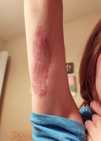 <p>Jessica Calvillo</p> Adalynn's brown recluse bite healing