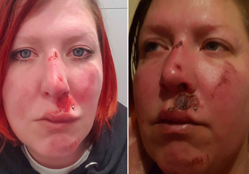 Charity volunteer Jen was left with a bloodied face and bruises all over her body (Caters)