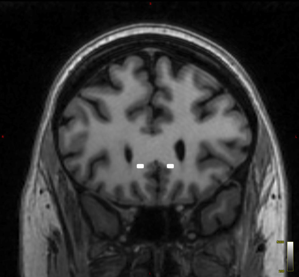 This brain scan image provided by Mount Sinai in 2024 shows the targeted sites for electrodes implanted in patient Emily Hollenbeck for use with deep brain stimulation therapy. Researchers say the treatment could eventually help many of the nearly 3 million Americans like her with depression that resists other treatments. (Mount Sinai via AP)