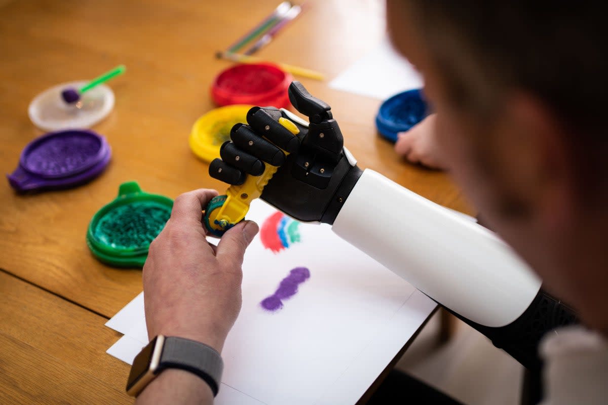 Darren Fuller is the first person to receive a 3D-printed bionic arm on the NHS (Open Bionics/PA) (PA Media)