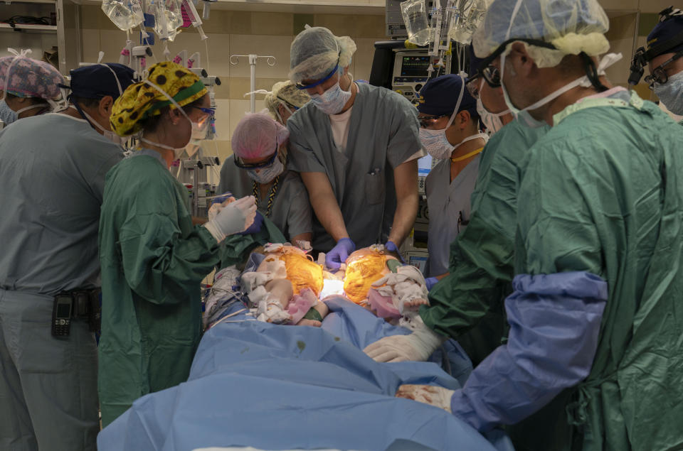 The twins during their separation surgery. (Joe Hallisy / Michigan Medicine)