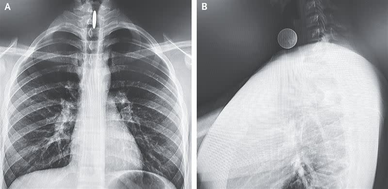 美國加州14歲少年誤食25分美元硬幣，硬幣垂直卡在聲帶間長達6小時。（圖／翻攝新英格蘭醫學期刊）