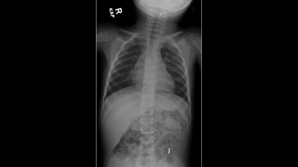 A boy, 3, is seen with magnetic balls lodged in his throat and abdomen.