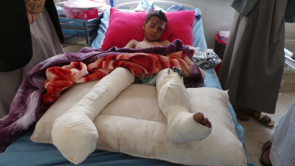 An injured child rests in a hospital a day after an airstrike in Saada, Yemen on Friday, Aug. 10, 2018. Yemen's Shiite rebels are backing a United Nations' call for an investigation into a Saudi-led coalition airstrike in the country's north that killed dozens of people the previous day, including many children.(AP Photo/Kareem al-Mrrany)