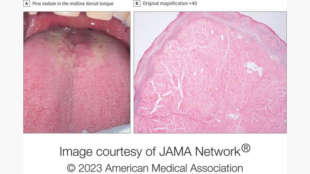 Mysterious Bump On A Man's Tongue Had An 'Extremely Rare' Cause ...