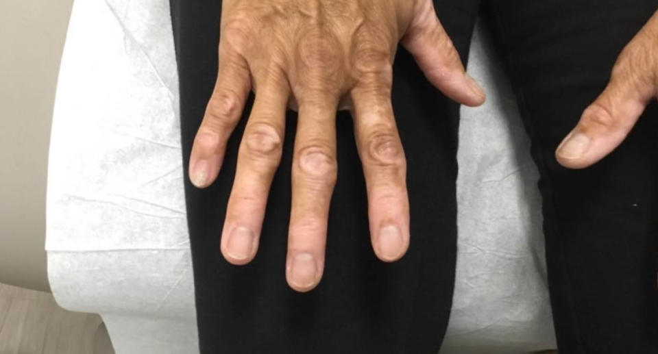 A 67-year-old woman's hands are pictured with vitiligo. 