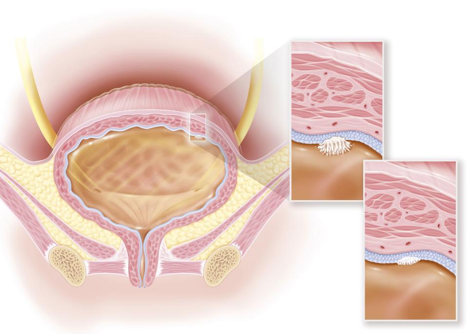 Stage 0a and 0is superficial bladder cancer, urothelial and in situ carcinoma. This illustration shows a woman's bladder with, in the upper right of the bladder wall, an in situ stage 0is carcinoma. A zoom at the level of the bladder wall with all its structures allows to see the appearance of this high grade tumor, represented in white. The tumor is still limited to the layer of the most superficial cells of the wall of the bladder, it is larger than the stage 0a tumor (non-invasive papillary urothelial carcinoma). (Photo by: BSIP/Education Images/Universal Images Group via Getty Images)