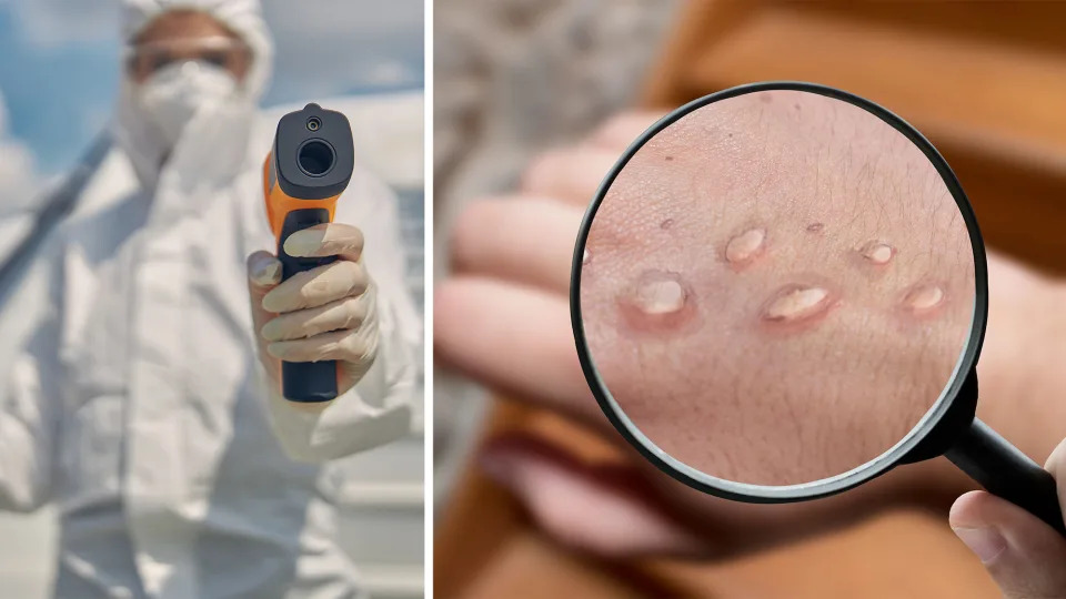 Composite picture of a person in hazmat suit and monkey pox stock image. (PHOTOS: Getty Images)