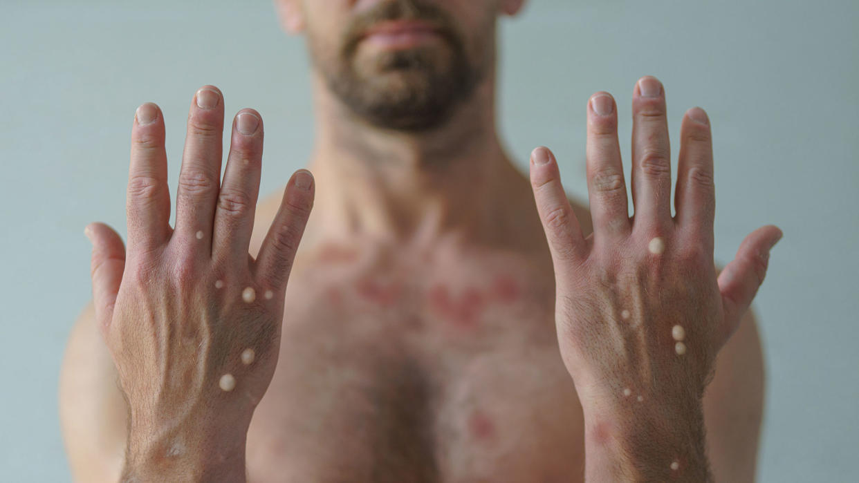 What's the monkeypox situation in Singapore like? (PHOTO: Getty Images)