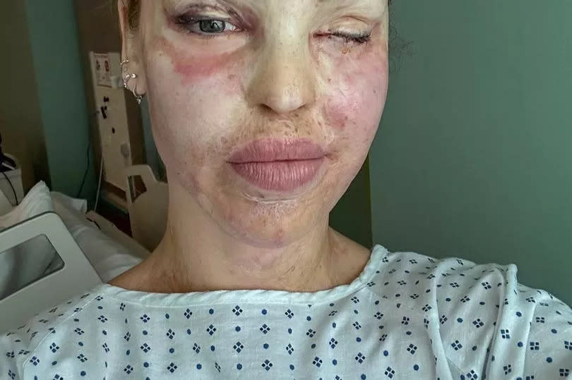 Katie Piper recently underwent further surgery on her eye