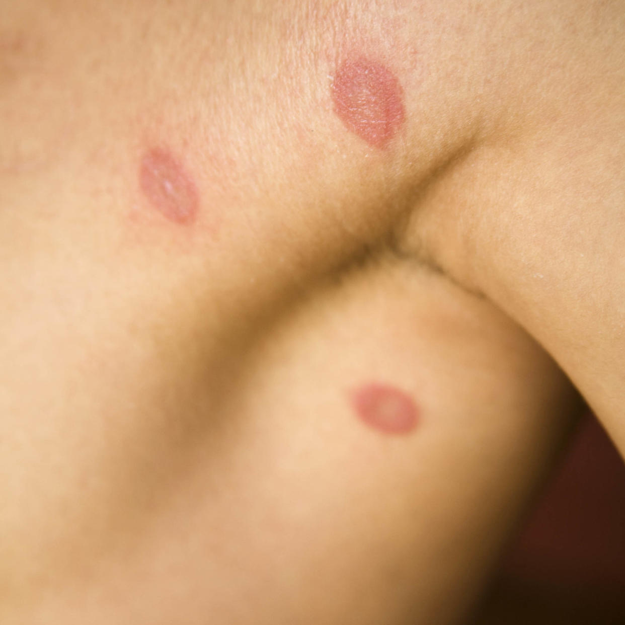 Human ringworm (Getty Images)