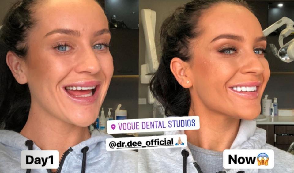 Ines got the work done at Vogue Dental Studios in Melbourne, where they gave her a whole new look, using porcelain veneers. Photo: Instagram/Ines Basic