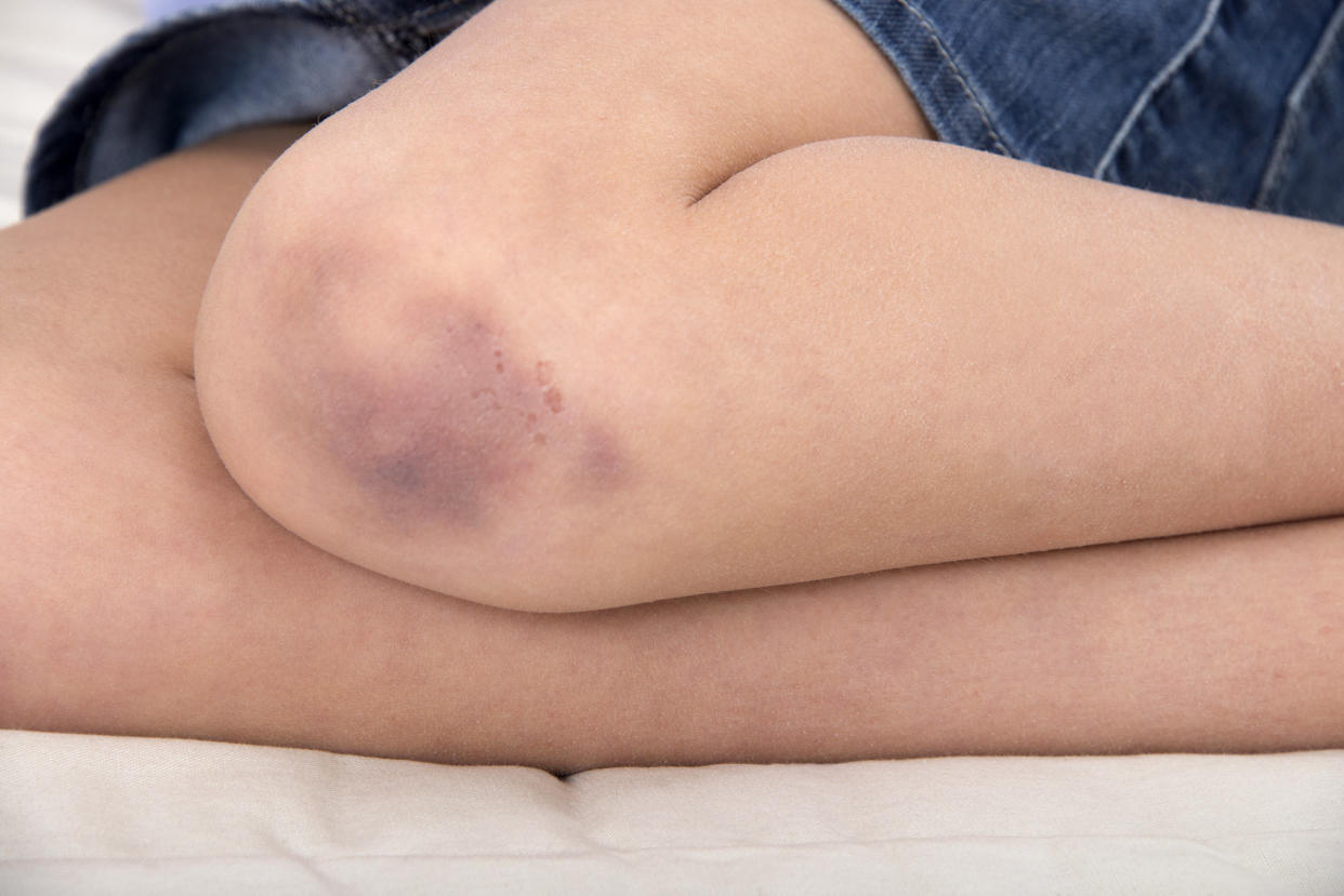 Experts say there a few common reasons why you might bruise more easily than others. (Photo: LEA PATERSON/SCIENCE PHOTO LIBRARY via Getty Images)