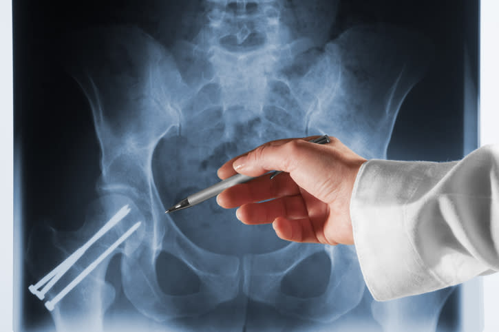 A doctor's hand points at a hip X-ray with a pen. The X-ray shows surgical screws in the hip area