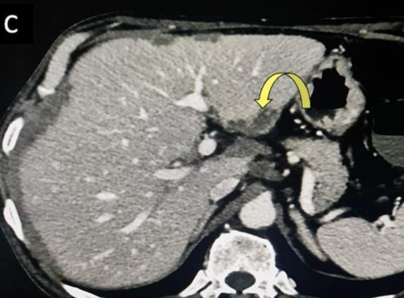 A CT scan shows a 'frosted liver' inside a 53-year-old man.