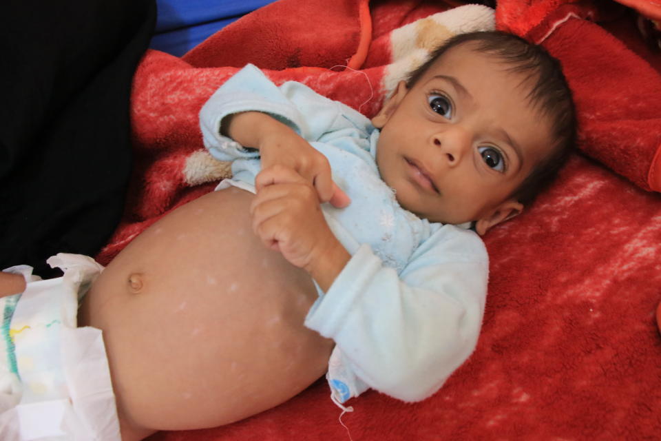 Ten-month-old Naji suffered from a severe type of malnutrition called kwashiorkor. (Photo: Ahmad Algohbary)