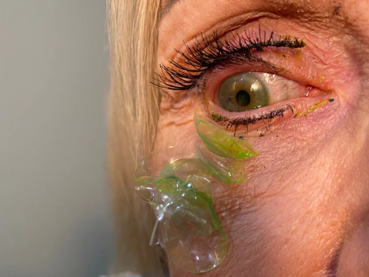 I recently removed 23 contact lenses from a patient's eye. In my 20 years as a d..