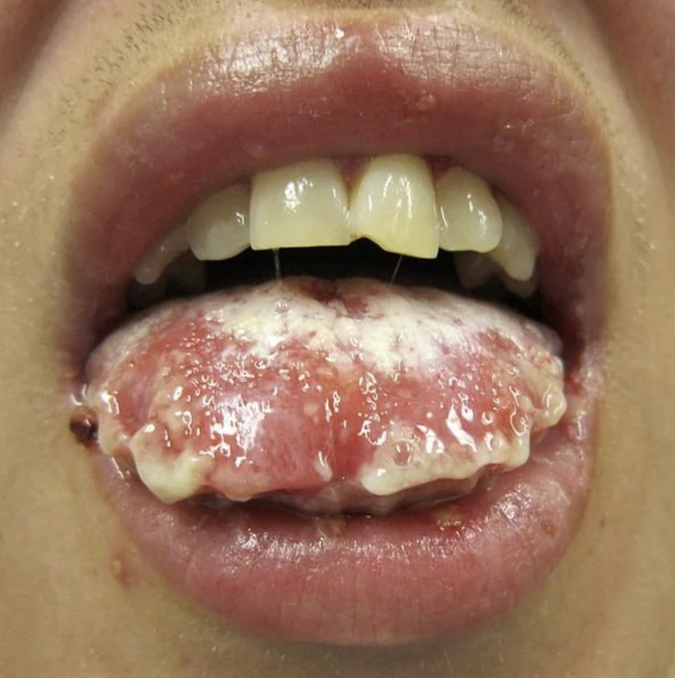 Close-up of a person's mouth showing a tongue with pale, dripping growths