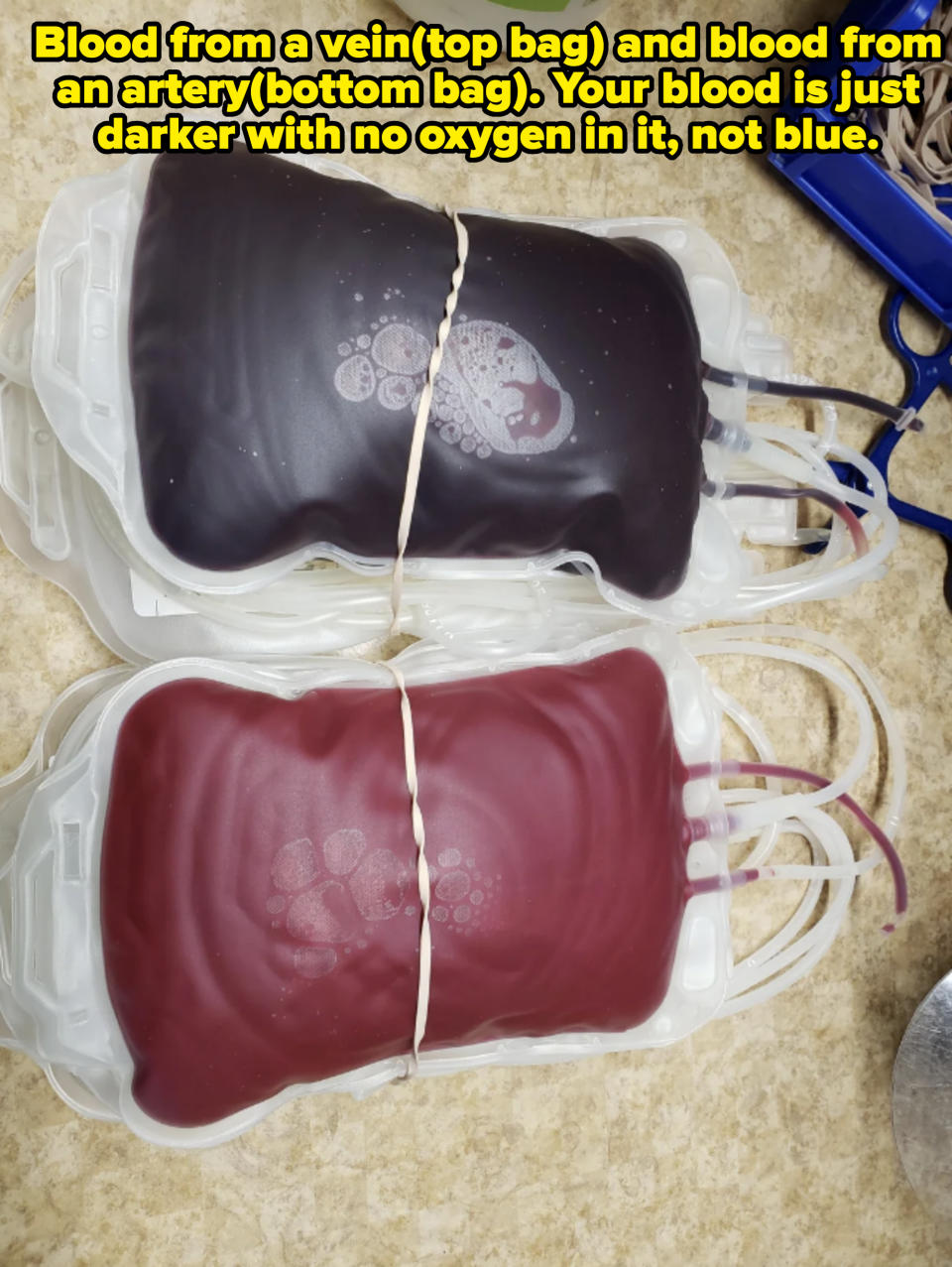 Two labeled blood bags, one darker and one lighter, placed on a medical countertop. White elastic bands secure the tubing on each bag