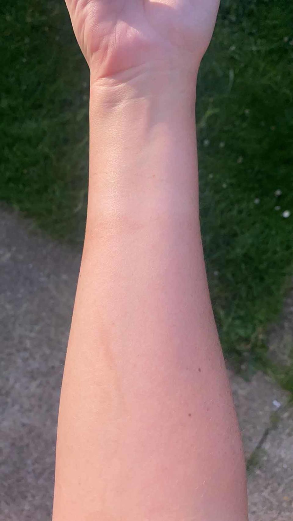 Paige’s arm has healed after using the oil. PA REAL LIFE COLLECT