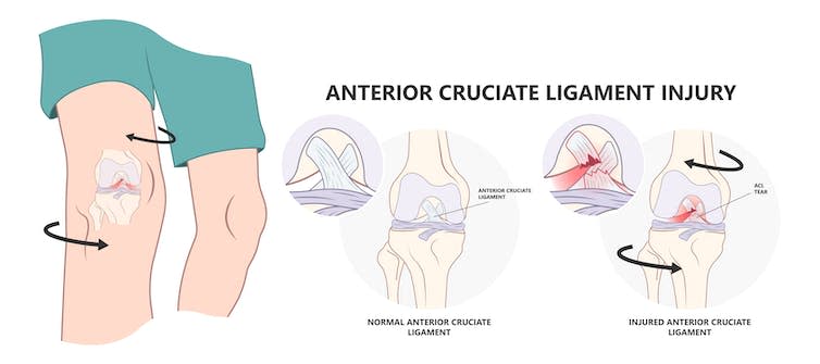 A diagram showing an ACL injury.