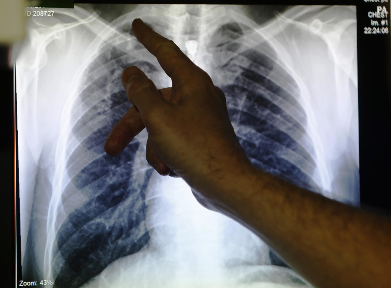 An X-ray of a person&rsquo;s lungs infected with tuberculosis. The disease kills 1.6 million people a year worldwide. (Photo: Luke MacGregor / Reuters)