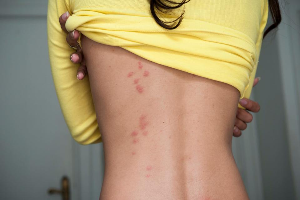 A woman lifts her top to show bedbug bites in a zigzag pattern on the left side of her back