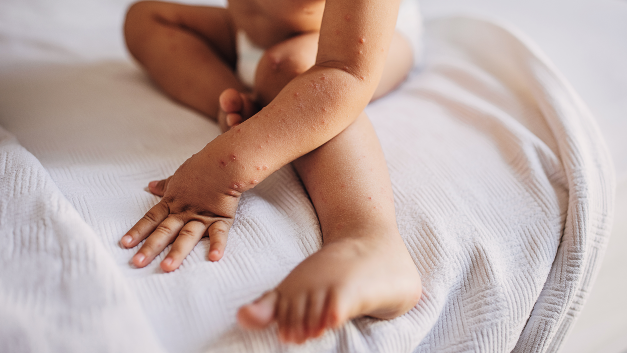 Measles outbreak on a child's arms and legs.