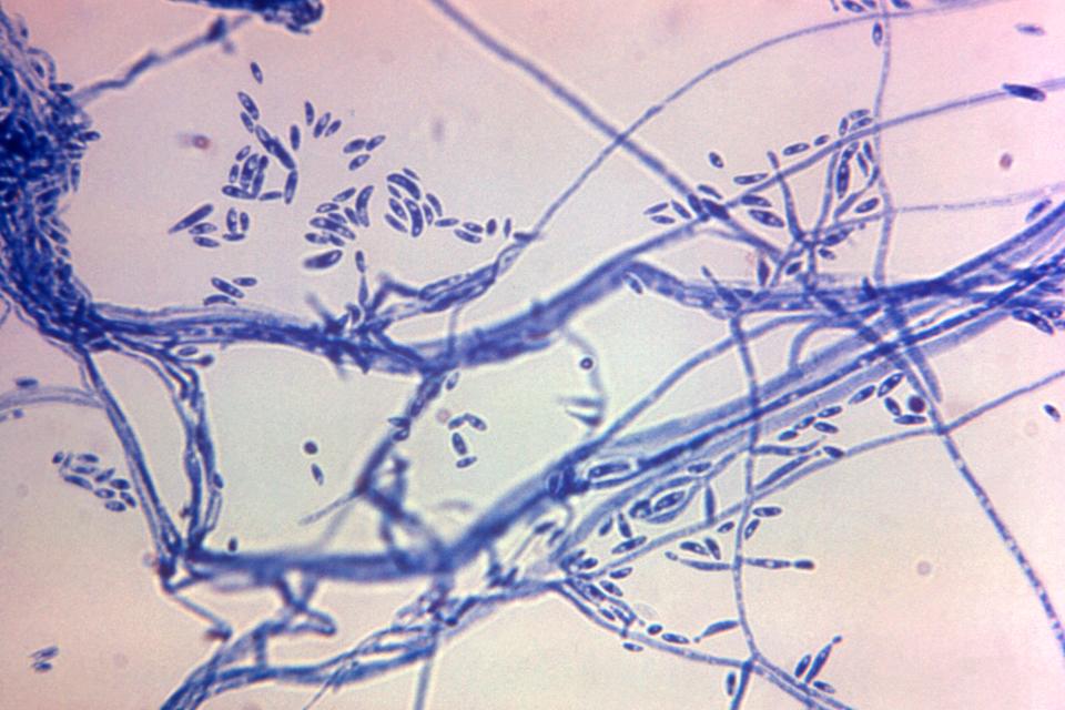 This microscope photo provided by the Centers for Disease Control and Prevention shows a Fusarium sp. fungal organism in 1972. The U.S. CDC says the death toll has risen to six in an outbreak of fungal meningitis tied to surgical procedures in a city along the U.S.-Mexico border, and they have not been able to reach everyone who may be at risk of infection. Labs have detected fungal signals consistent with Fusarium solani species complex from the cerebrospinal fluid of patients receiving follow-up care in Mexico or the United States. (Dr. Lucille K. Georg/CDC via AP) ORG XMIT: NY429