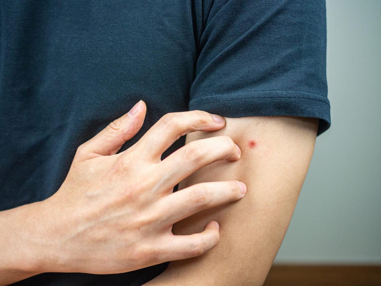 man with bug bite on arm close up