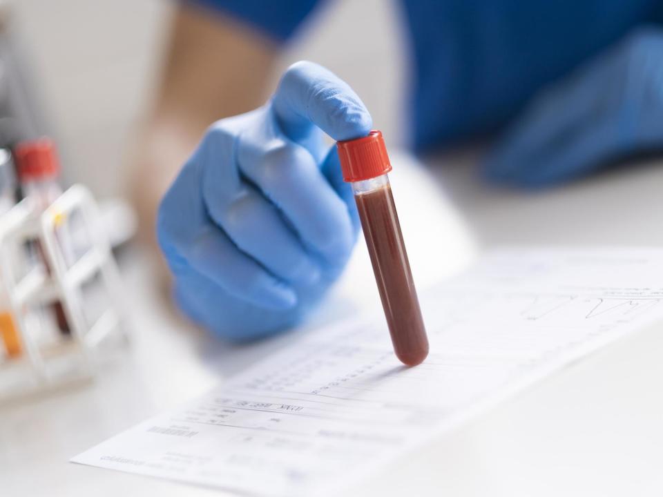 A simple blood test could tell how well someone would respond to treatment for prostate cancer, researchers have said: iStock