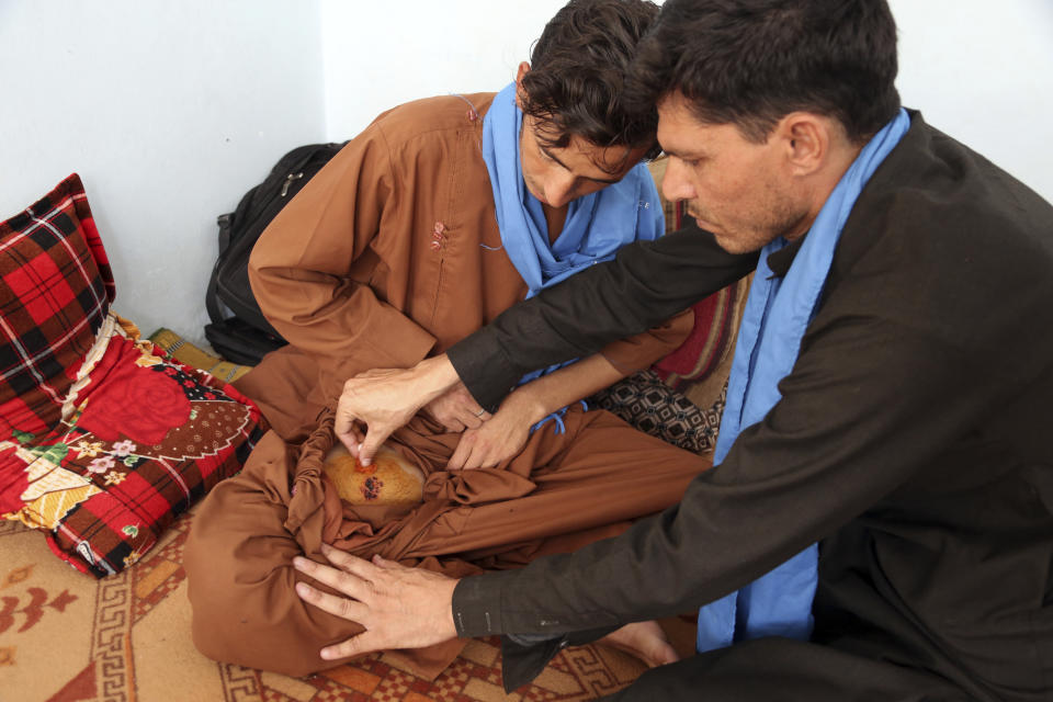 In this Thursday, Aug. 29, 2019, photo, Sayed Rahim Omid, 23, a peace marcher show his painful wound during an interview with the Associated Press in Kabul, Afghanistan. For almost a year, Afghanistan’s more than 30 million people have been in the awkward position of waiting as a United States envoy and the Taliban negotiate their country’s fate behind closed doors. An agreement on ending America’s longest war, which the U.S. once hoped to reach by Sunday, Sept. 1, not only could set a timeline for U.S. troops’ withdrawal but also nudge aside this month’s presidential election and open the way for a Taliban return to power.(AP Photo/Rahmat Gul)