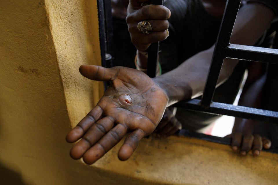 A Kush user shows his injury through a window at a medical outreach center of Sierra Leone's Youth Development and Child Link (SLYDCL), an NGO that provides medical care and psychological needs for drug users, Friday, April 26, 2024 . The drug leaves people lethargic, desperate and ill. While the government does not publish official figures on kush-related deaths or hospital admissions, Ansu Konneh, the director of mental health at the Ministry of Social Welfare, said there had been a sharp rise in people addicted to kush. (AP Photo/ Misper Apawu)