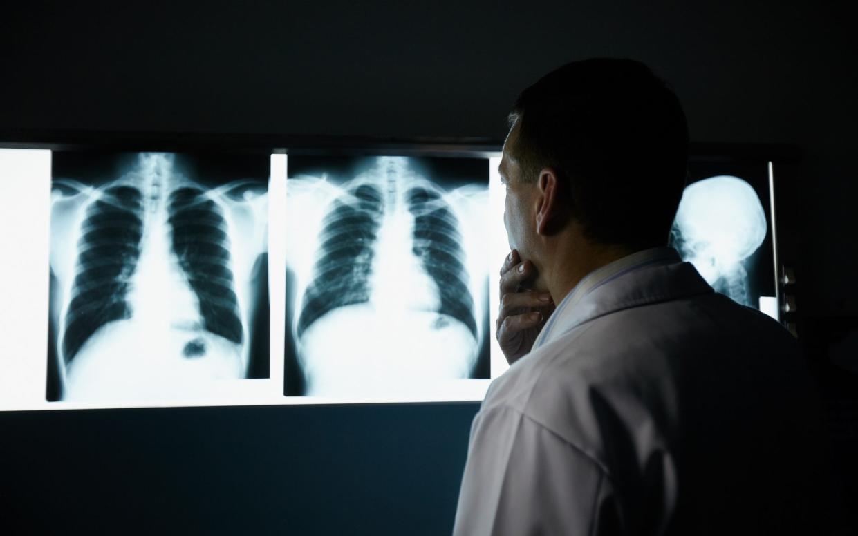 A doctor looking as x-rays - iStockphoto