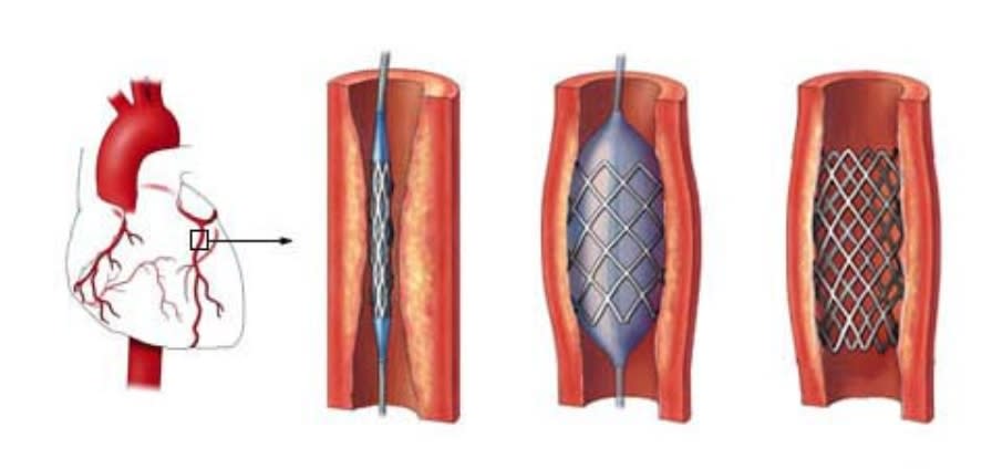 利用冠狀動脈支架(Stents)治療動脈硬化（圖：衛生福利部雙和醫院）
