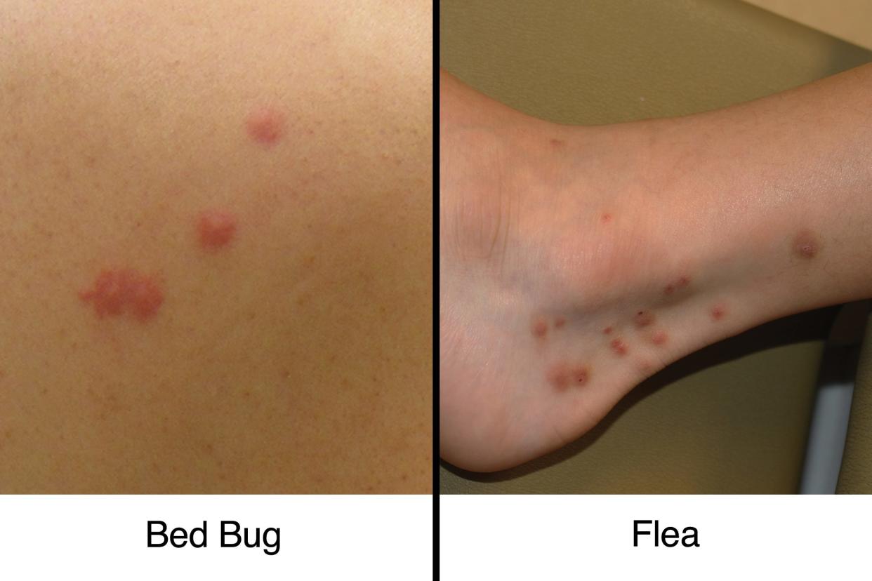 bed bug bites vs flea bites