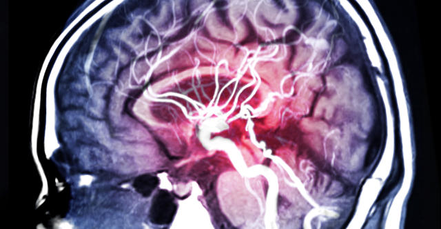 MRA Brain or Magnetic resonance angiography (MRI)  of Vessel in the brain sagittal view for evaluate them  stenosis (abnormal narrowing), occlusions, aneurysms (vessel wall dilatations, at risk of rupture) or other abnormalities. The Circle of Willis is a circle of vessels around the base of the brain where most aneurysms are found. (Getty Images)