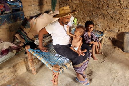 Ali Muhammad, father of malnourished Muath Ali Muhammad, holds him at their home in Aslam district of the northwestern province of Hajja