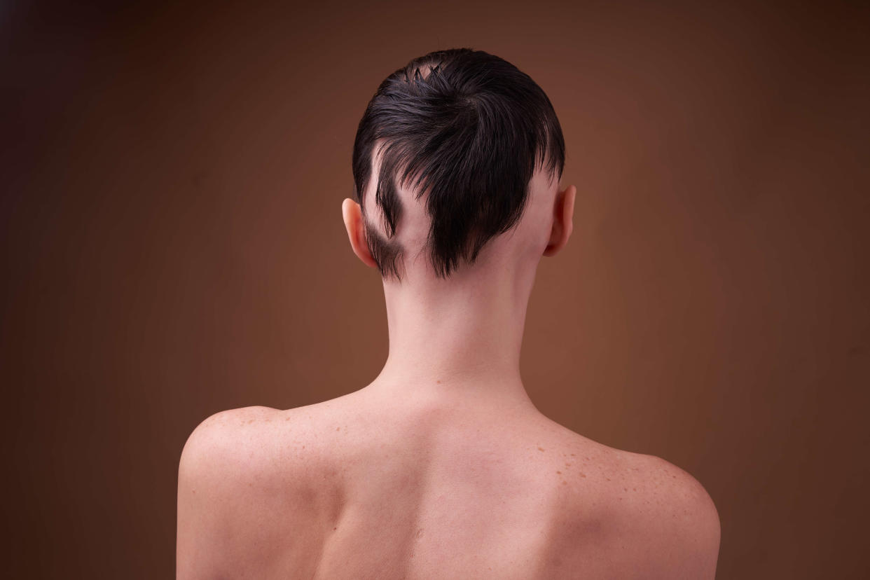 A young woman with alopecia. Hair loss problem, young woman from behind in profile with baldness on a beige background. Brunette shirtless woman. The concept of human support, female power, social inequality, hereditary disease, connection, mental health, acceptance, body positivity, diversity and inclusion.