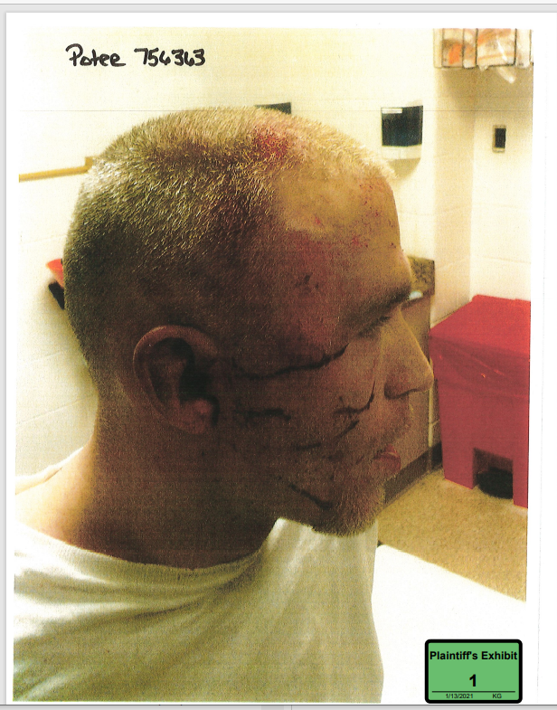 Andrew Potee is suing prison guards at the Corrections Reception Center for injuries he received.