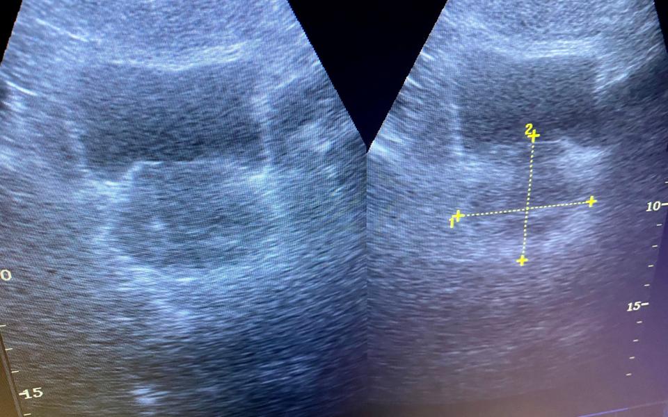 Image of enlarged prostate gland on ultrasound screen - PS3000/iStockphoto