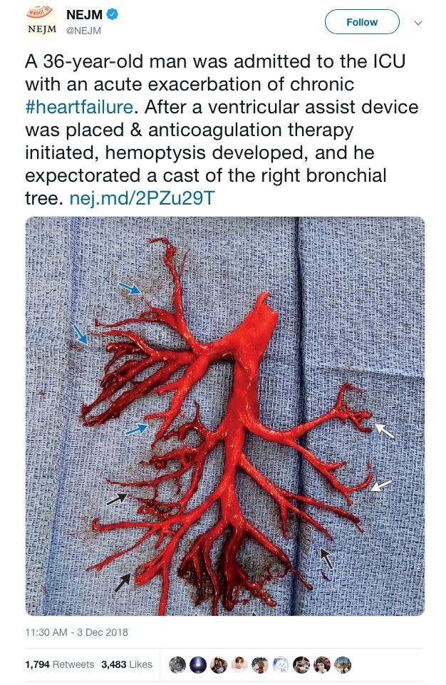 Man coughs up bizarre blood clot shaped exactly like part of a lung