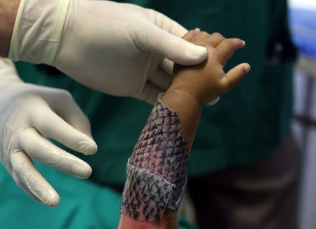 Doctors wrap a child's burnt skin with sterilised tilapia fish skin at Dr. Jose Frota Institute in the northeastern costal city of Fortaleza, Brazil, May 3, 2017. REUTERS/Paulo Whitaker