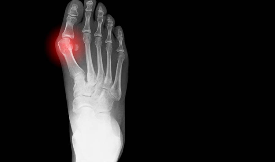 The Truth About Bunions, the Foot Problem Everyone's Embarrassed to Talk About 
