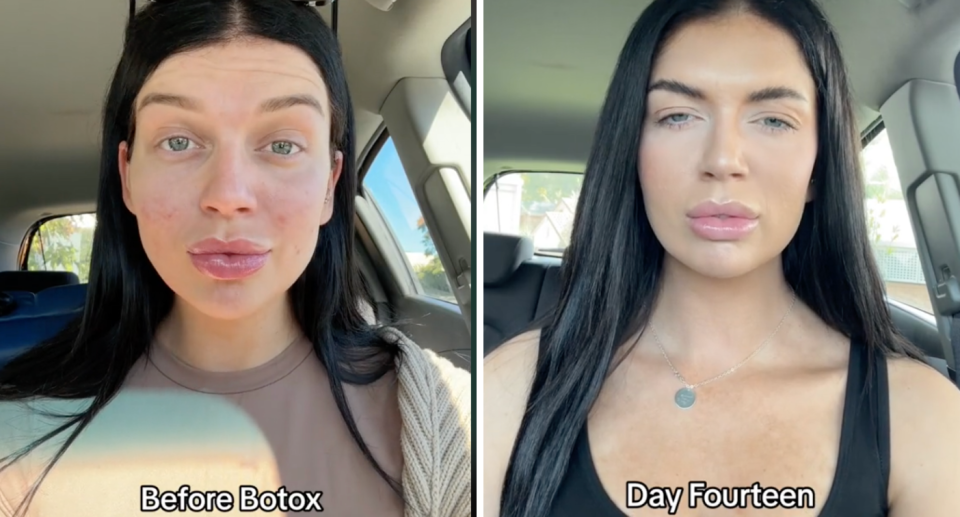 MAFS' Caitlin McConville shows her post-Botox transformation 