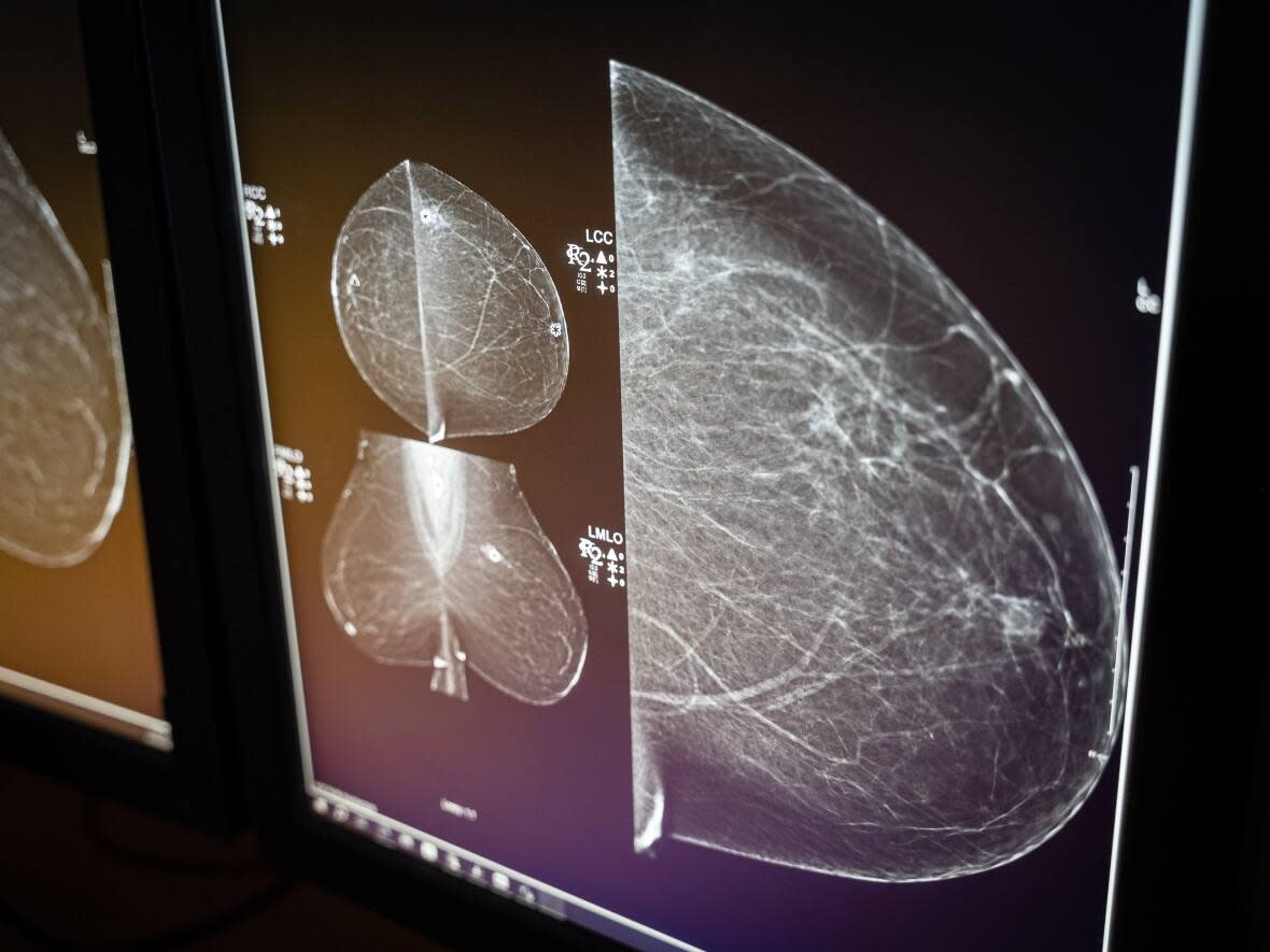 Canada's national guidelines recommend against breast cancer screening for women in their 40s, despite growing evidence in favour of it. A group of experts say the Canadian Task Force on Preventive Health Care's recommendations are outdated and lagging behind what other jurisdictions are doing to detect various forms of cancer early. (CBC News - image credit)